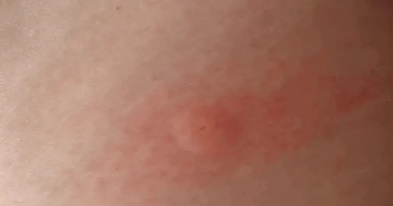 Guida Dettagliata alle Punture di Insetti e Parassiti 🐜🕷️🦟