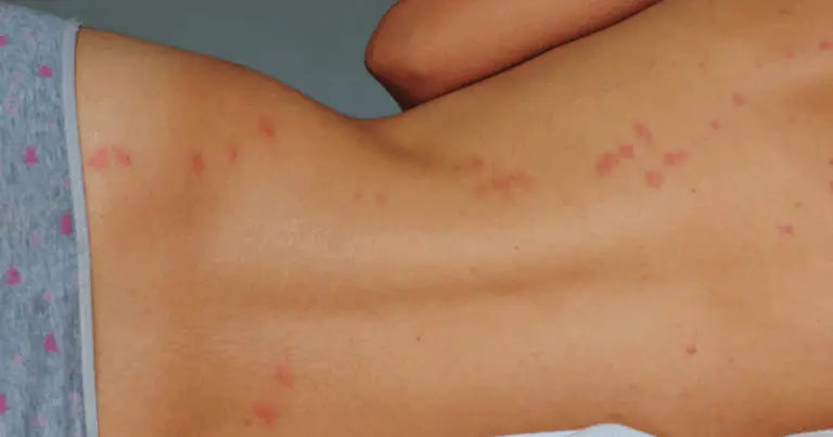 Identificare le punture: come riconoscere le morsicature degli insetti più comuni e come reagire prontamente