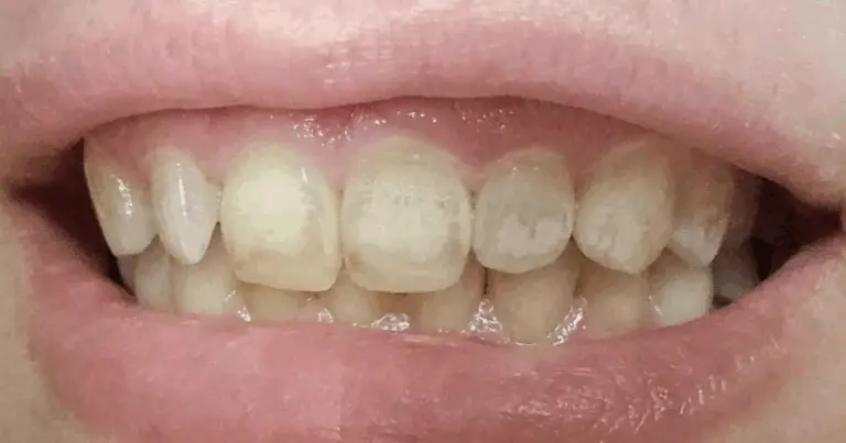 Svelati i Segnali della Carenza di Calcio: Guida Completa per Rinforzare Ossa e Denti 💪🦷