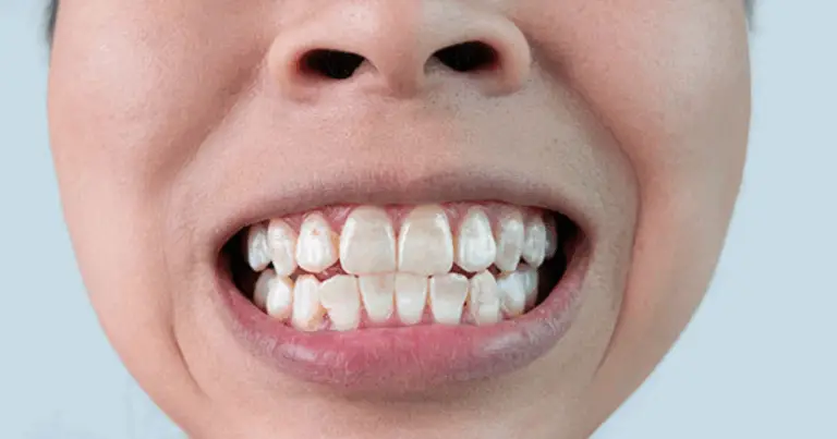 Il tuo corpo ti avvisa: scopri se ti manca calcio e come intervenire oggi stesso🥛💪