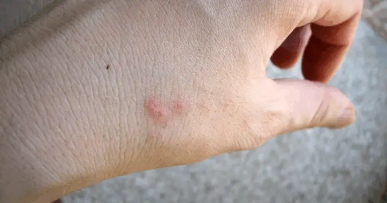 Guida definitiva alle punture di insetti: riconosci, previeni e cura con efficacia