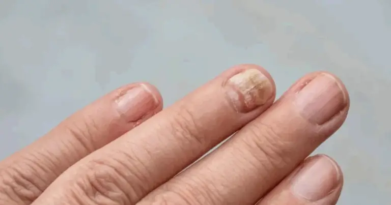 Malattie non fungine delle unghie delle mani: guida completa per riconoscerle e curarle