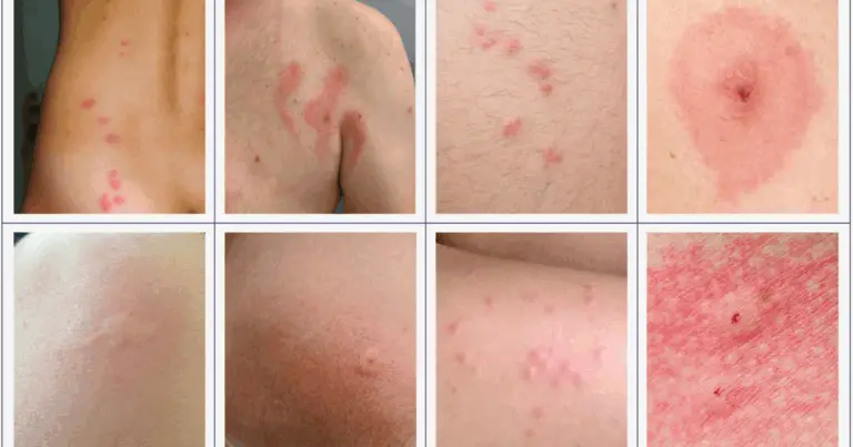 Guida completa per riconoscere e gestire le punture di insetti