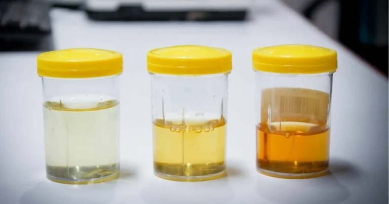 Il colore dell’urina: cosa indica davvero e come interpretarlo correttamente