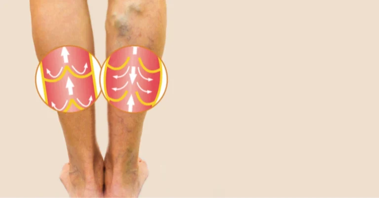 Cattiva circolazione sanguigna: segnali da riconoscere e soluzioni efficaci