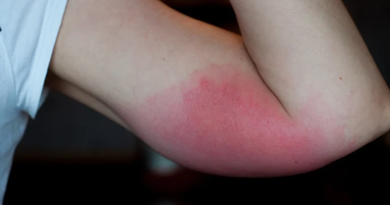 Tipi di punture di insetti: come riconoscerle, effetti e prevenzione